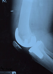 Xray result of the right knee